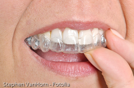 Invisible braces